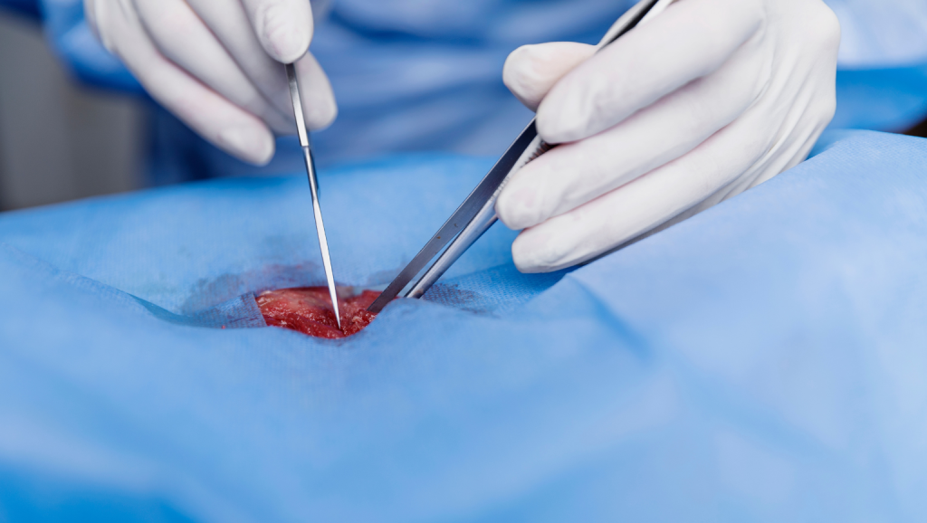 Hemorrhoid Surgery (Piles Treatment)