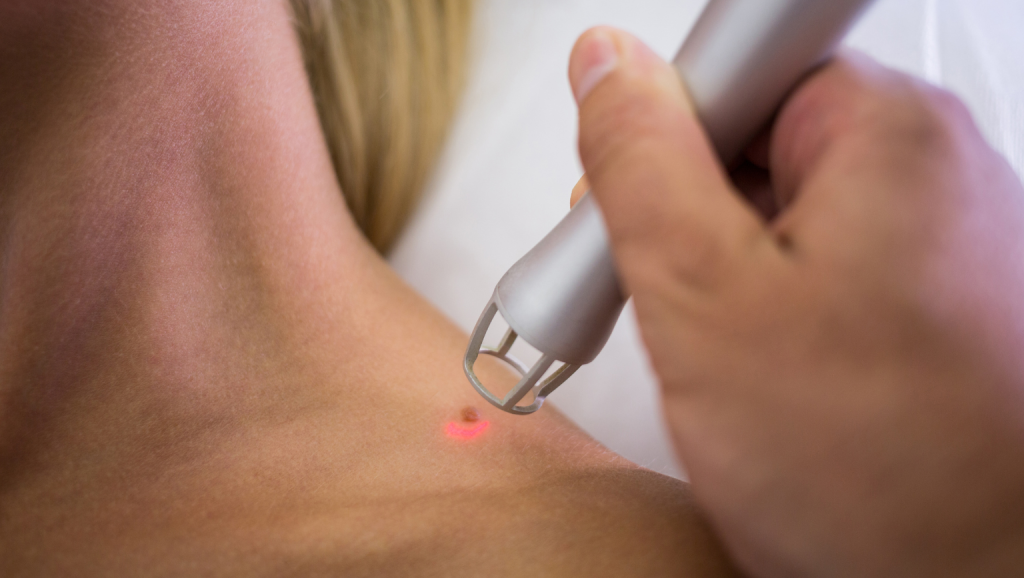 Laser Acupuncture in Tarlac | Non-Invasive Pain Relief