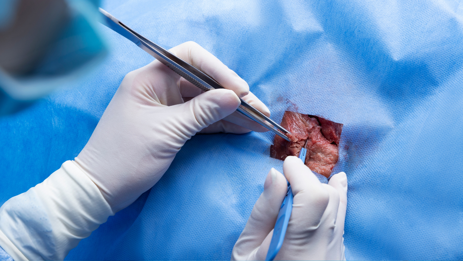 Lumpectomy